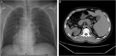 Interventional treatment of basilar trunk artery aneurysms associated with situs inversus totalis: A case report